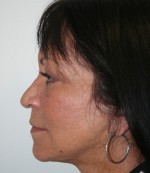 Face Lift