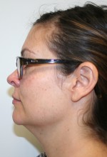 Liposuction