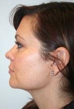 Liposuction