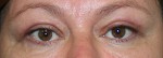 Eyelid Surgery (Blepharoplasty)