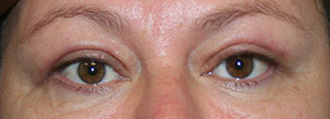Eyelid Surgery (Blepharoplasty)
