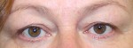 Eyelid Surgery (Blepharoplasty)