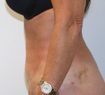 Liposuction