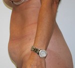 Liposuction