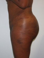 Buttock Augmentation