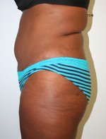 Buttock Augmentation