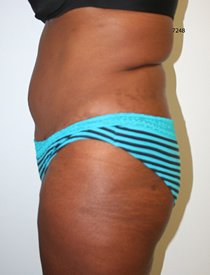 Buttock Augmentation