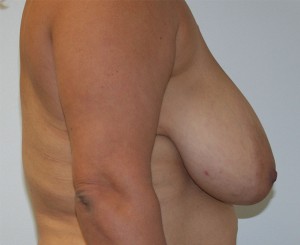 Breast Lift (Mastopexy)