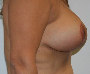 Breast Lift (Mastopexy)
