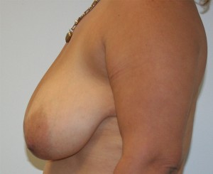 Breast Lift (Mastopexy)