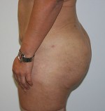 Buttock Augmentation