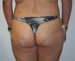 Buttock Augmentation