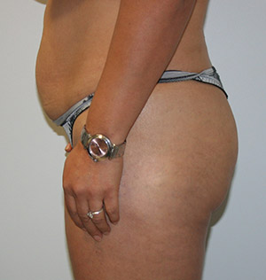 Buttock Augmentation