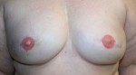 Breast Reconstruction after Mastectomy