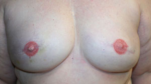 Breast Reconstruction after Mastectomy