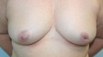 Breast Reconstruction after Mastectomy