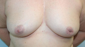 Breast Reconstruction after Mastectomy