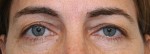 Eyelid Surgery (Blepharoplasty)