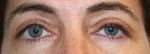 Eyelid Surgery (Blepharoplasty)