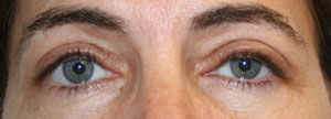 Eyelid Surgery (Blepharoplasty)
