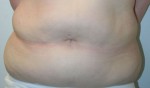 Tummy Tuck (Abdominoplasty)