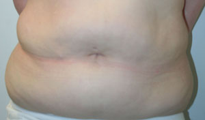 Tummy Tuck (Abdominoplasty)