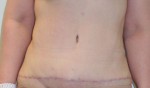 Tummy Tuck (Abdominoplasty)