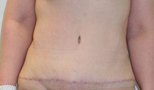 Tummy Tuck (Abdominoplasty)