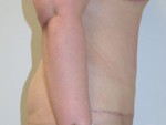 Tummy Tuck (Abdominoplasty)
