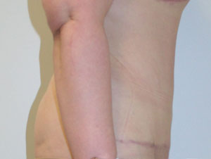 Tummy Tuck (Abdominoplasty)