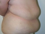 Tummy Tuck (Abdominoplasty)
