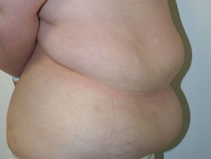 Tummy Tuck (Abdominoplasty)