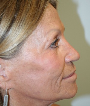 Nose Surgery (Rhinoplasty)