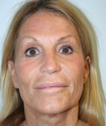 Nose Surgery (Rhinoplasty)