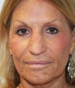 Nose Surgery (Rhinoplasty)