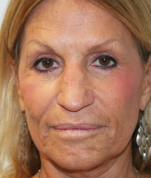 Nose Surgery (Rhinoplasty)