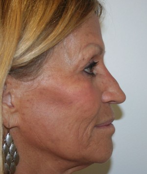 Nose Surgery (Rhinoplasty)