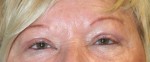 Eyelid Surgery (Blepharoplasty)