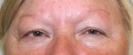 Eyelid Surgery (Blepharoplasty)