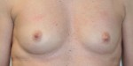 Breast Augmentation