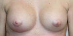 Breast Augmentation