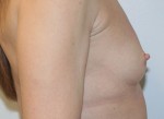 Breast Augmentation