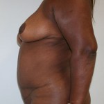 Tummy Tuck (Abdominoplasty)