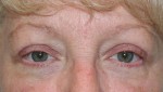 Eyelid Surgery (Blepharoplasty)