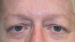 Eyelid Surgery (Blepharoplasty)