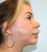 Face Lift