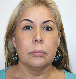 Face Lift