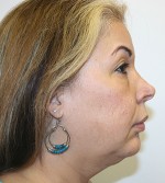 Face Lift