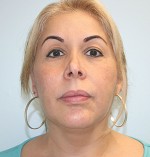 Face Lift