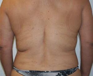 Liposuction